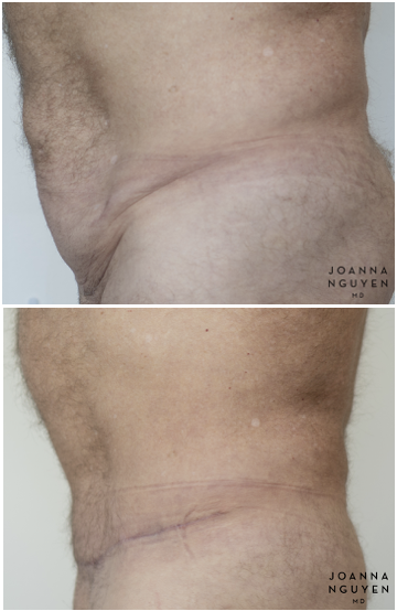 jnguyenmd.abdominoplasty3.5.png