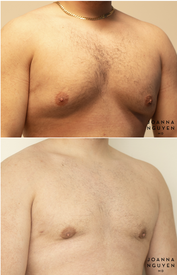 jnguyenmd.gynecomastia4.2.png