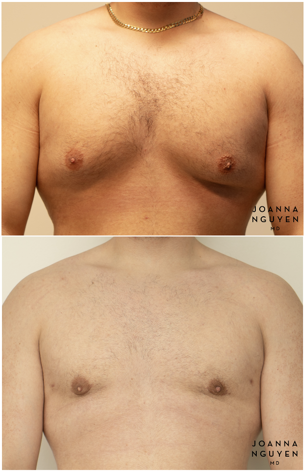 jnguyenmd.gynecomastia4.1.png