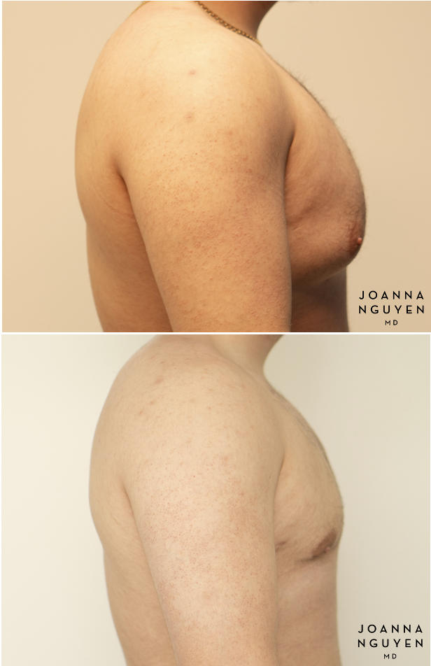 jnguyenmd.gynecomastia4.4.png