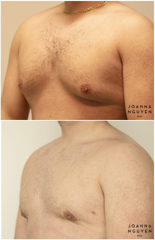 jnguyenmd.gynecomastia4.3.png