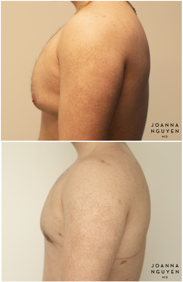 jnguyenmd.gynecomastia4.5.png