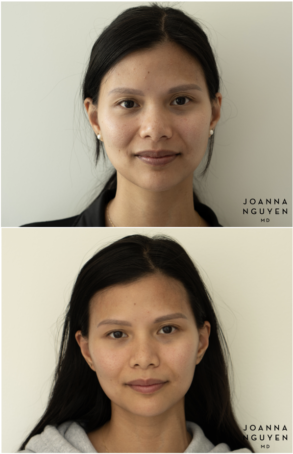 jnguyenmd.botox3.1.png