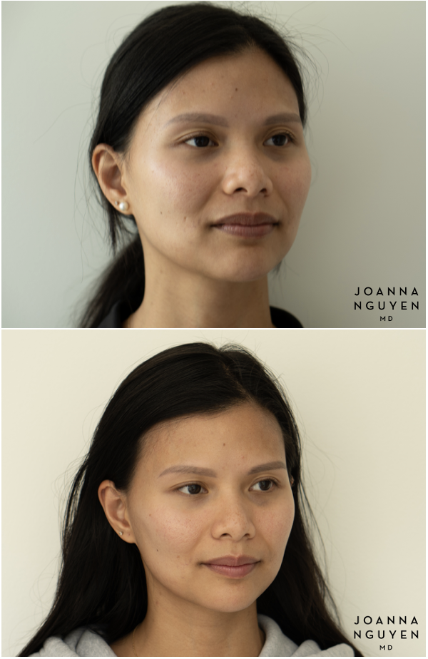 jnguyenmd.botox3.2.png