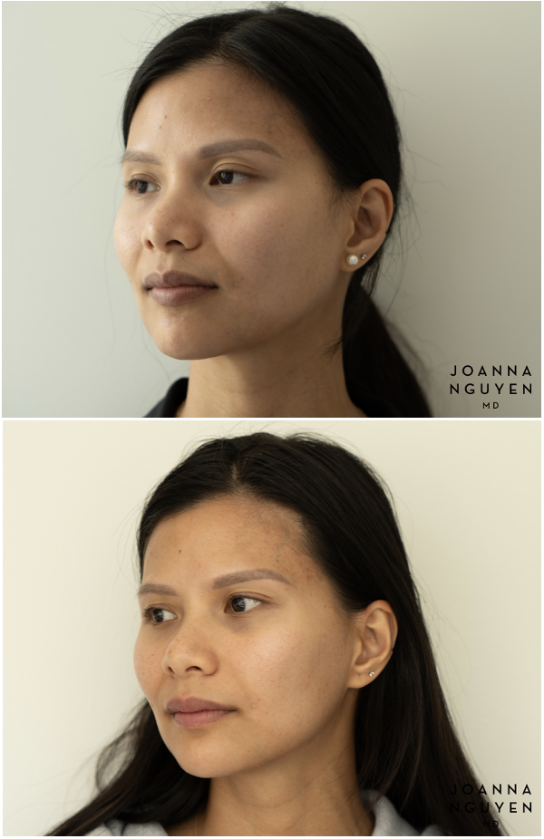 jnguyenmd.botox3.3.png