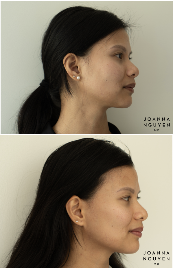 jnguyenmd.botox3.4.png