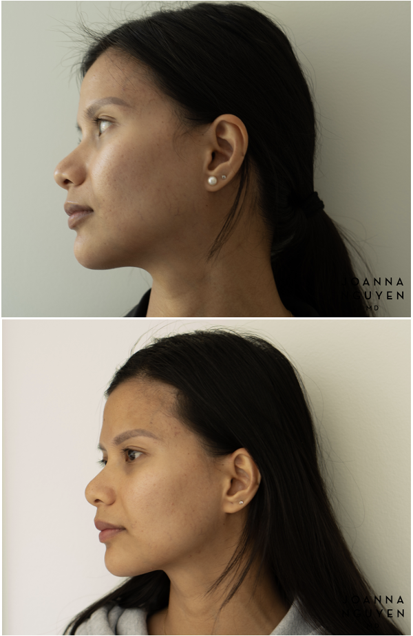 jnguyenmd.botox3.5.png
