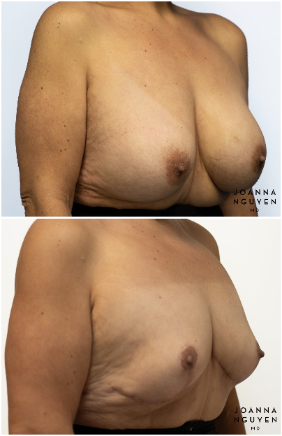 jnguyenmd.breast.reconstruction3.2.png