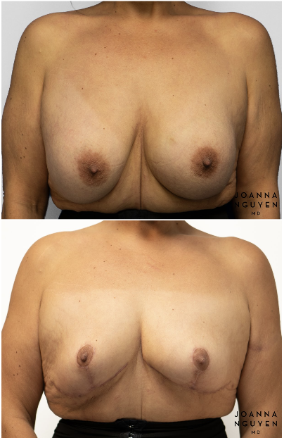 jnguyenmd.breast.reconstruction3.1.png