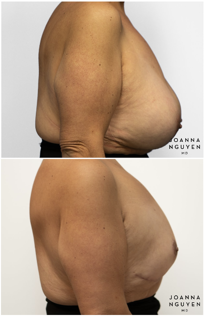 jnguyenmd.breast.reconstruction3.3.png