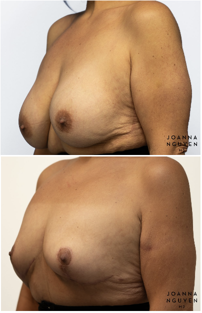 jnguyenmd.breast.reconstruction3.4.png