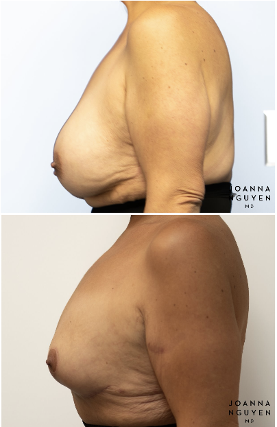 jnguyenmd.breast.reconstruction3.5.png