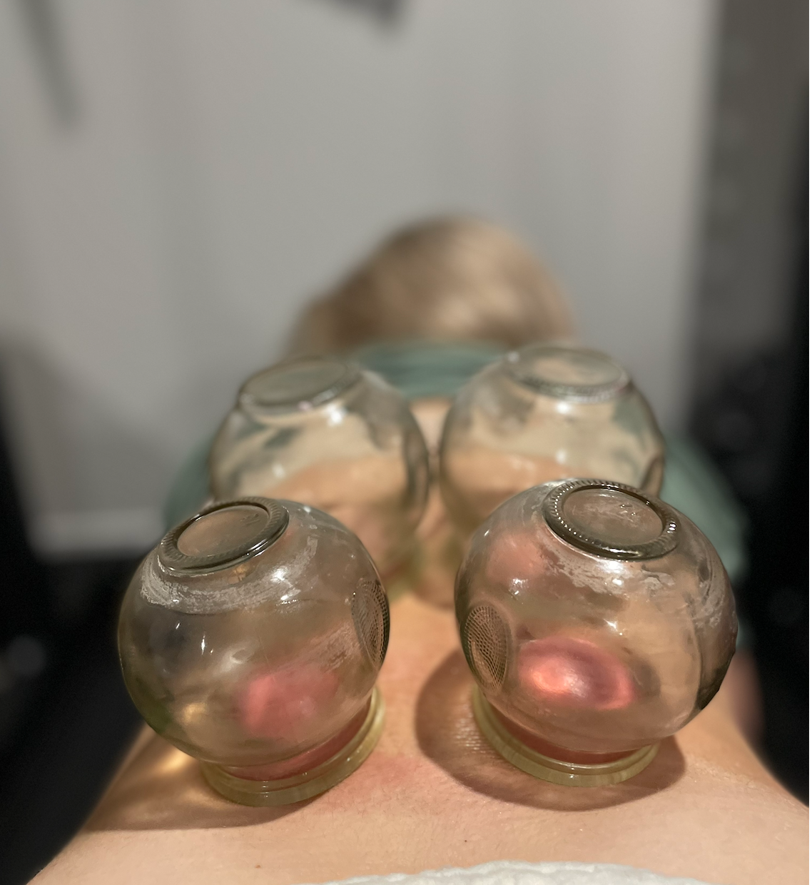 Does Cupping Work for Back &amp; Neck Pain?