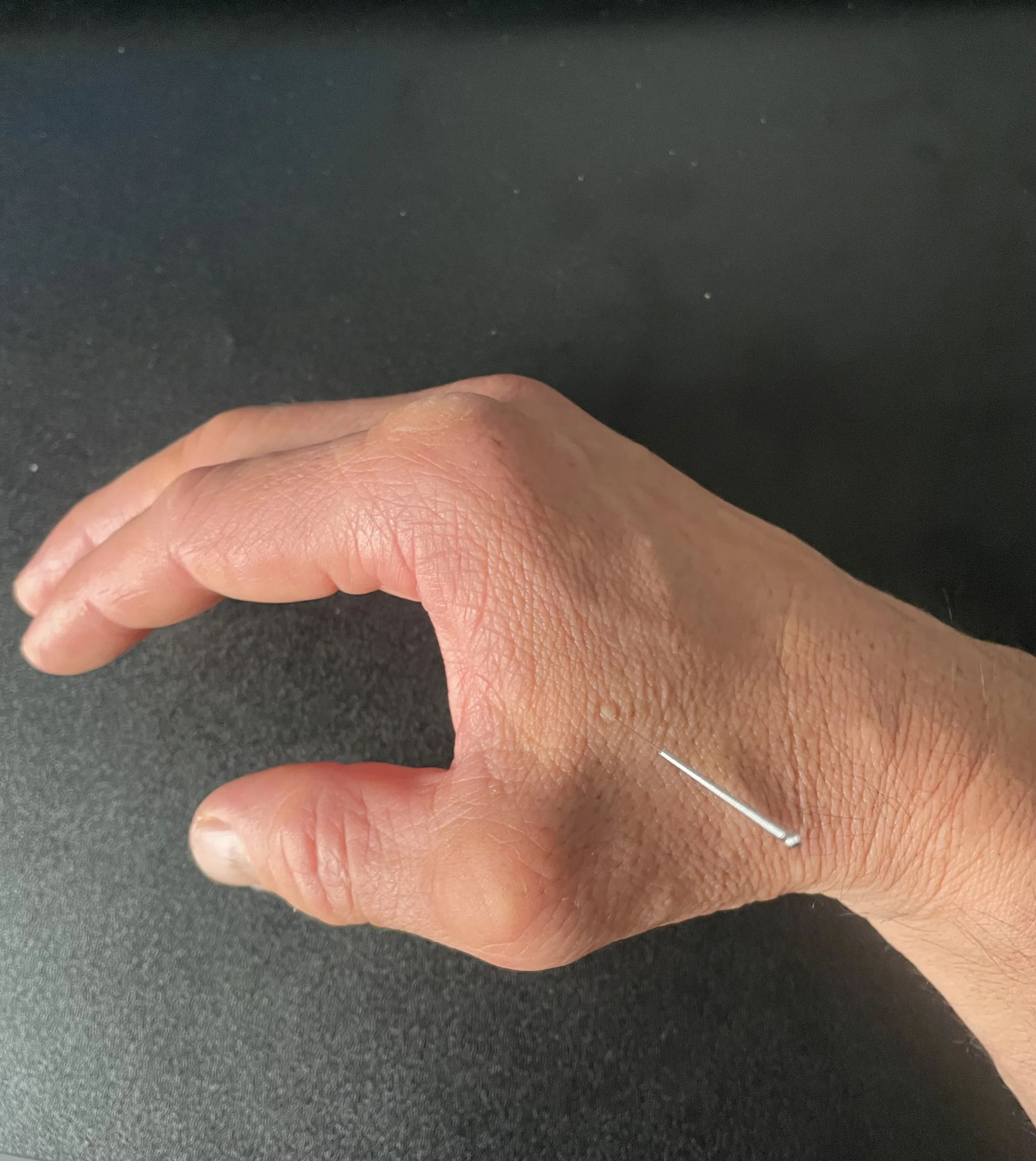 The LI4 Acupuncture Point: What It Is, What the Research Says, and Its Role in Wrist &amp; Thumb Pain