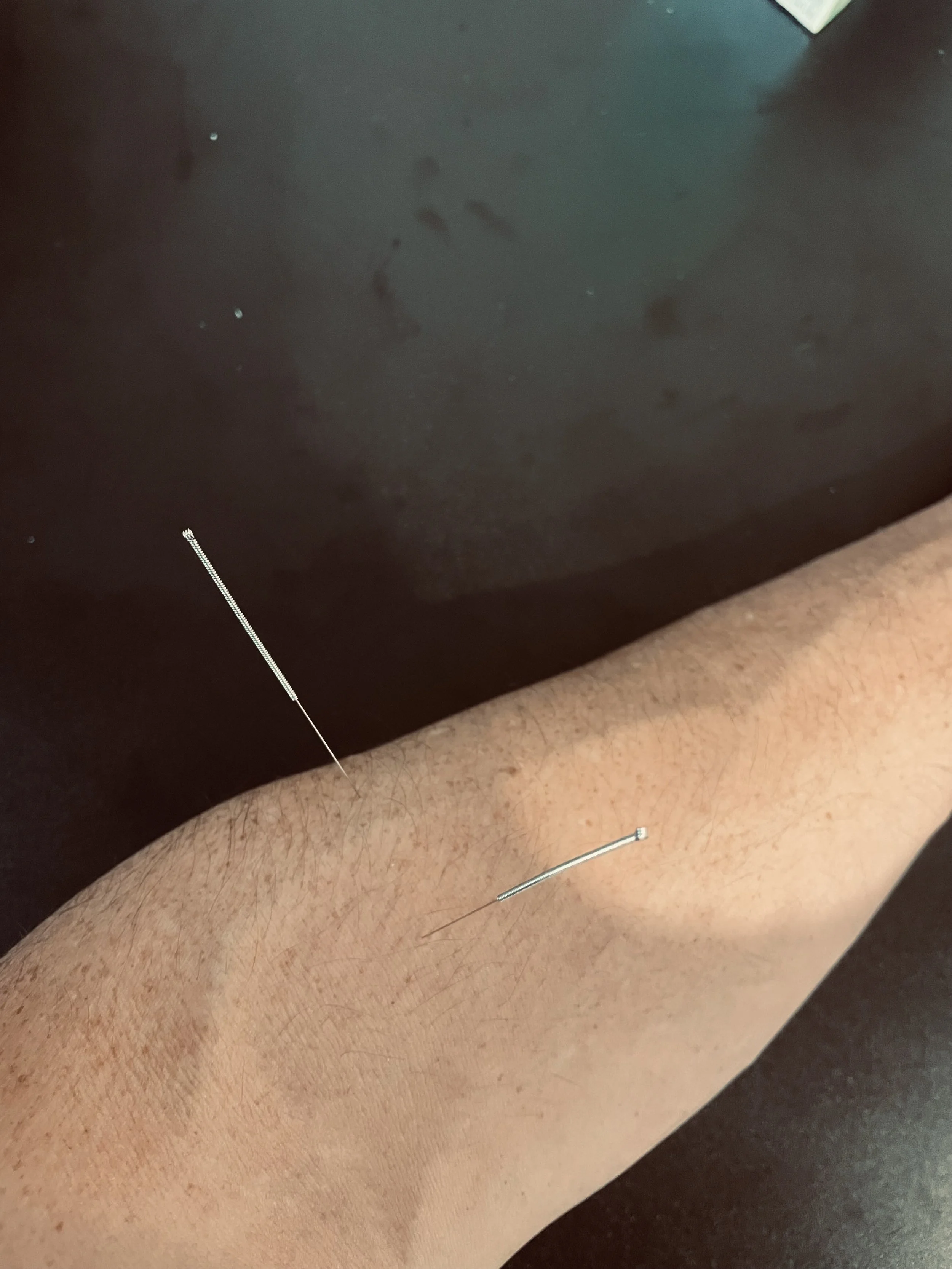 Tennis Elbow: Why Dry Needling Might Beat the Anti-Inflammatories
