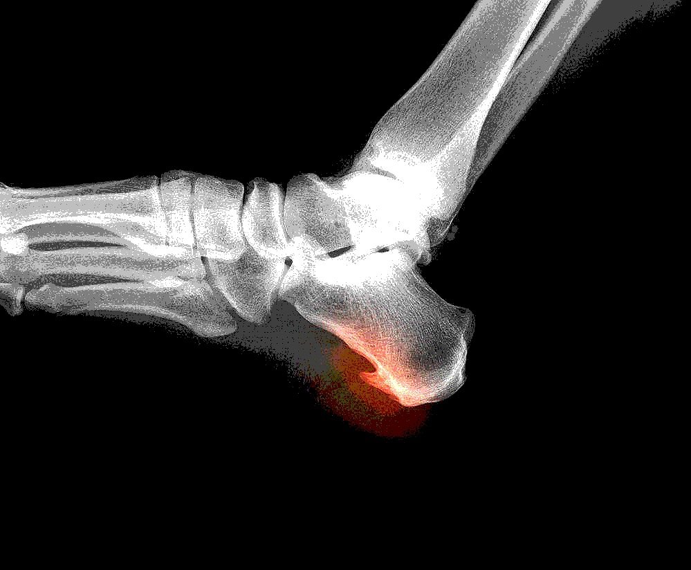 Fracture of the Heel Bone (Calcaneus) - Orthoriverside.com