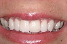 Cosmetic Smile Enhancement AFTER