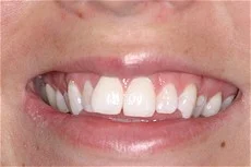 Cosmetic Smile Enhancement BEFORE