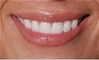 Crowns AFTER