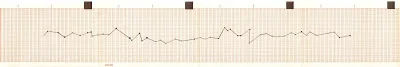 graf_ekg.jpeg