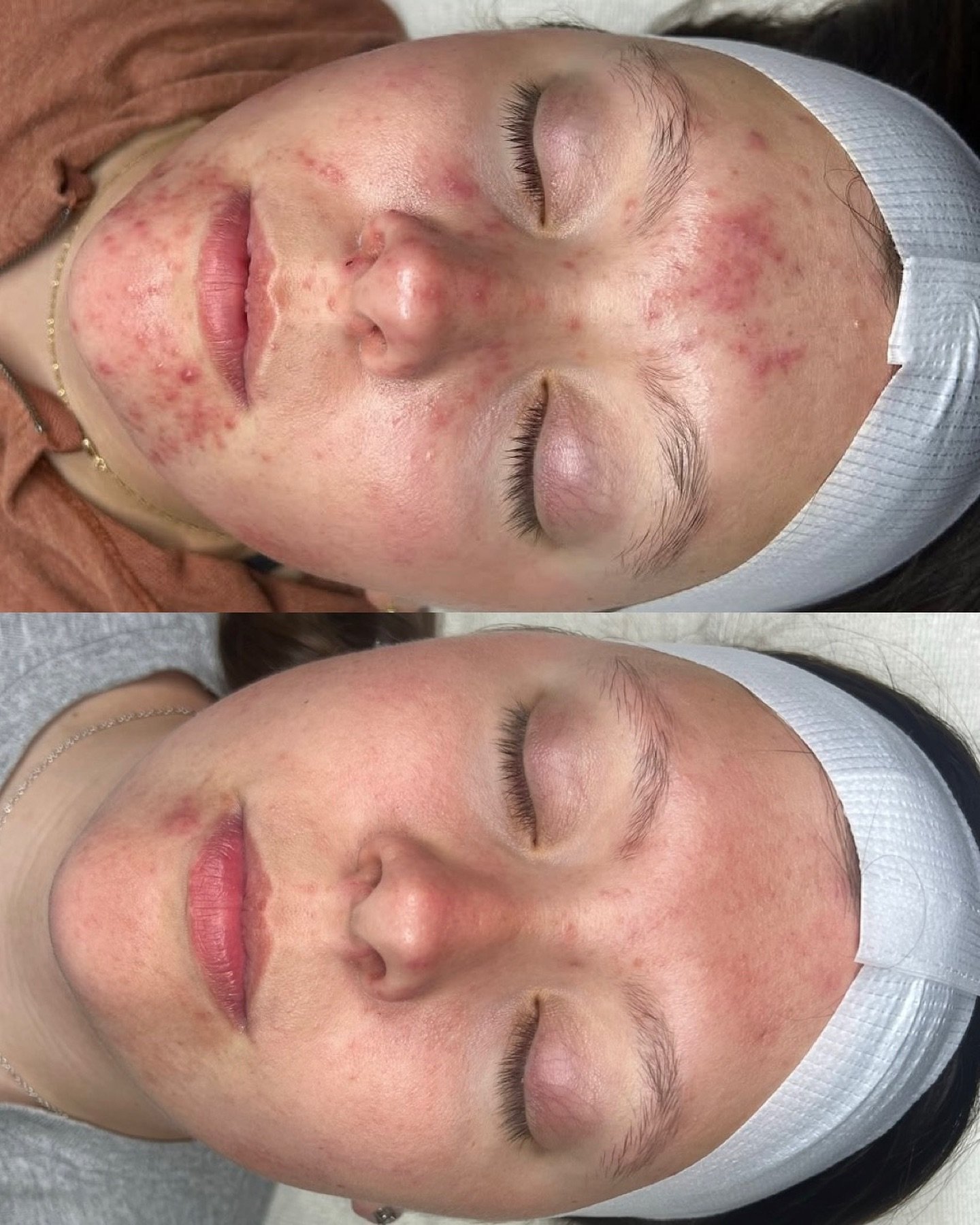 This is your reminder that healing takes time &mdash; this before + after says it all. 🙌🏼

A true testament to consistency, at home skin care, and custom skin treatments!👏🏼

🧖🏻&zwj;♀️ @brielleaesthetics 

📞 717.900.1390 | #BlossomYork