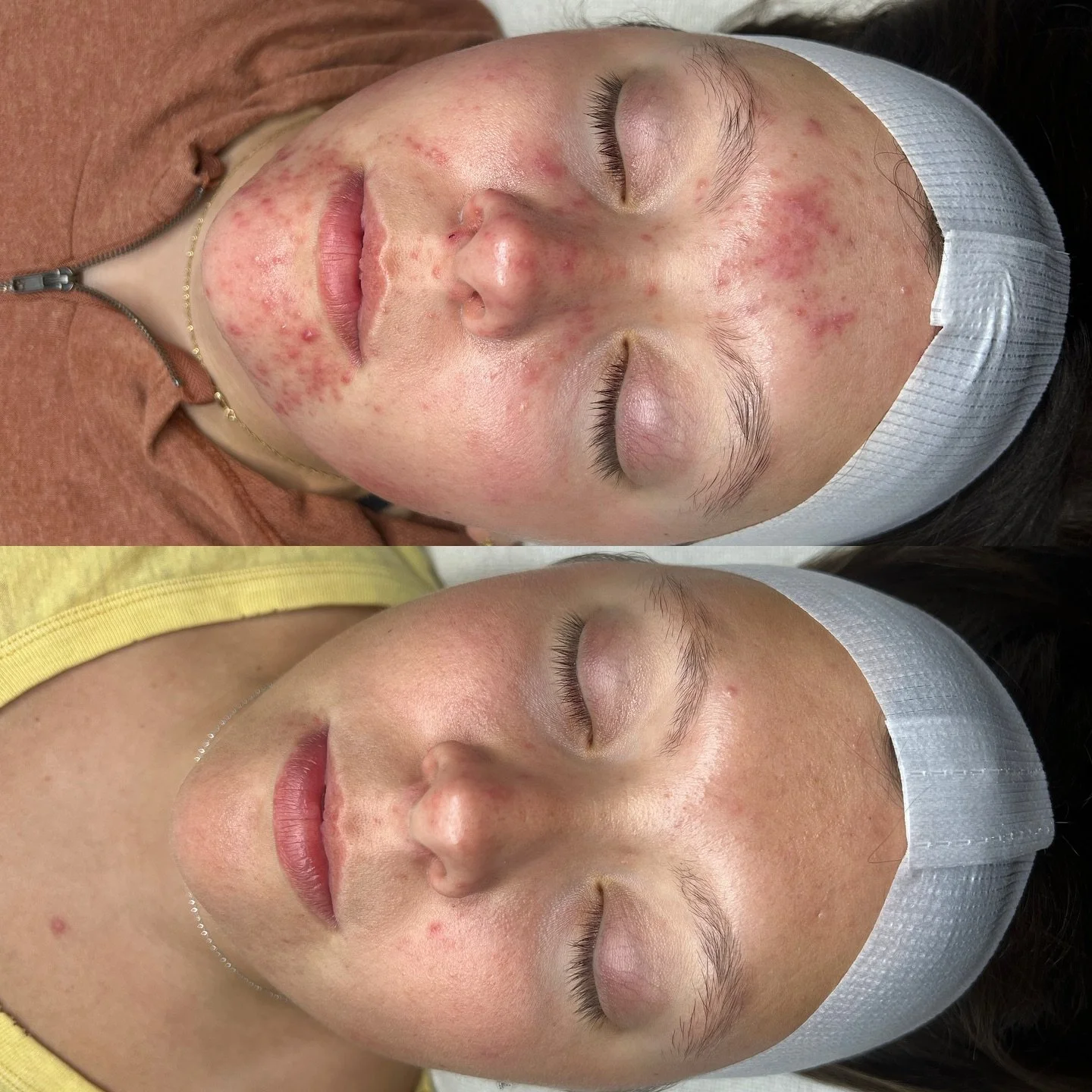 remember her? because we barely do 🥹

She trusted the process, stayed consistent, and showed up for herself every step of the way.

Now she radiates a confidence that&rsquo;s impossible to miss!🤍

🧖🏼&zwj;♀️ @brielleaesthetics 

📞 717.900.1390 | 