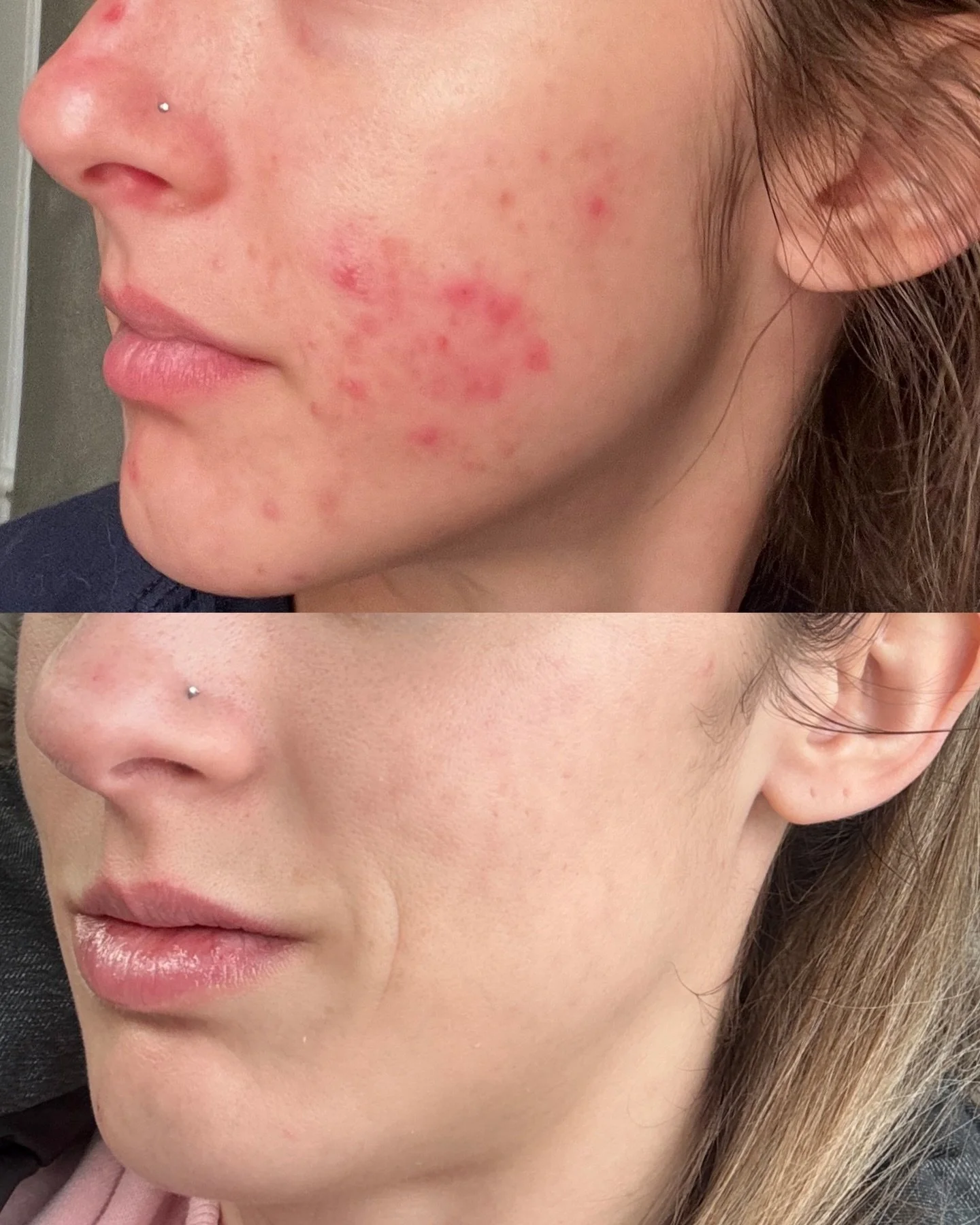 client documented before &amp; after 🙌🏼

This transformation reflects consistency and a personalized approach, combining both products and in office treatments tailored specifically to this client&rsquo;s skin health. ✨

🧖🏻&zwj;♀️ @jazzmin.aesthe