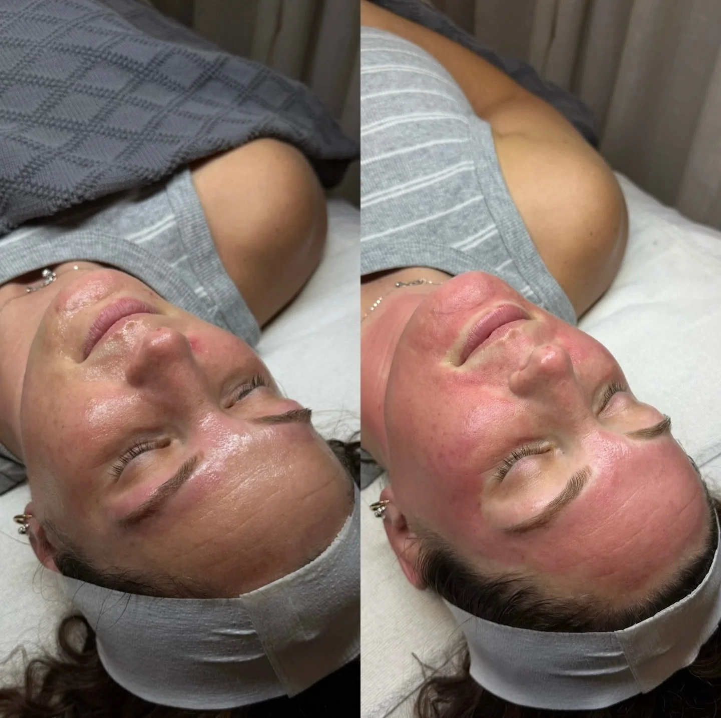 before and immediately after 🩸

The redness you see here is a normal, temporary inflammatory response and the first step toward smoother texture, refined pores, and healthier skin! 🙌🏼

Microneedling creates a micro injury in the skin to trigger yo