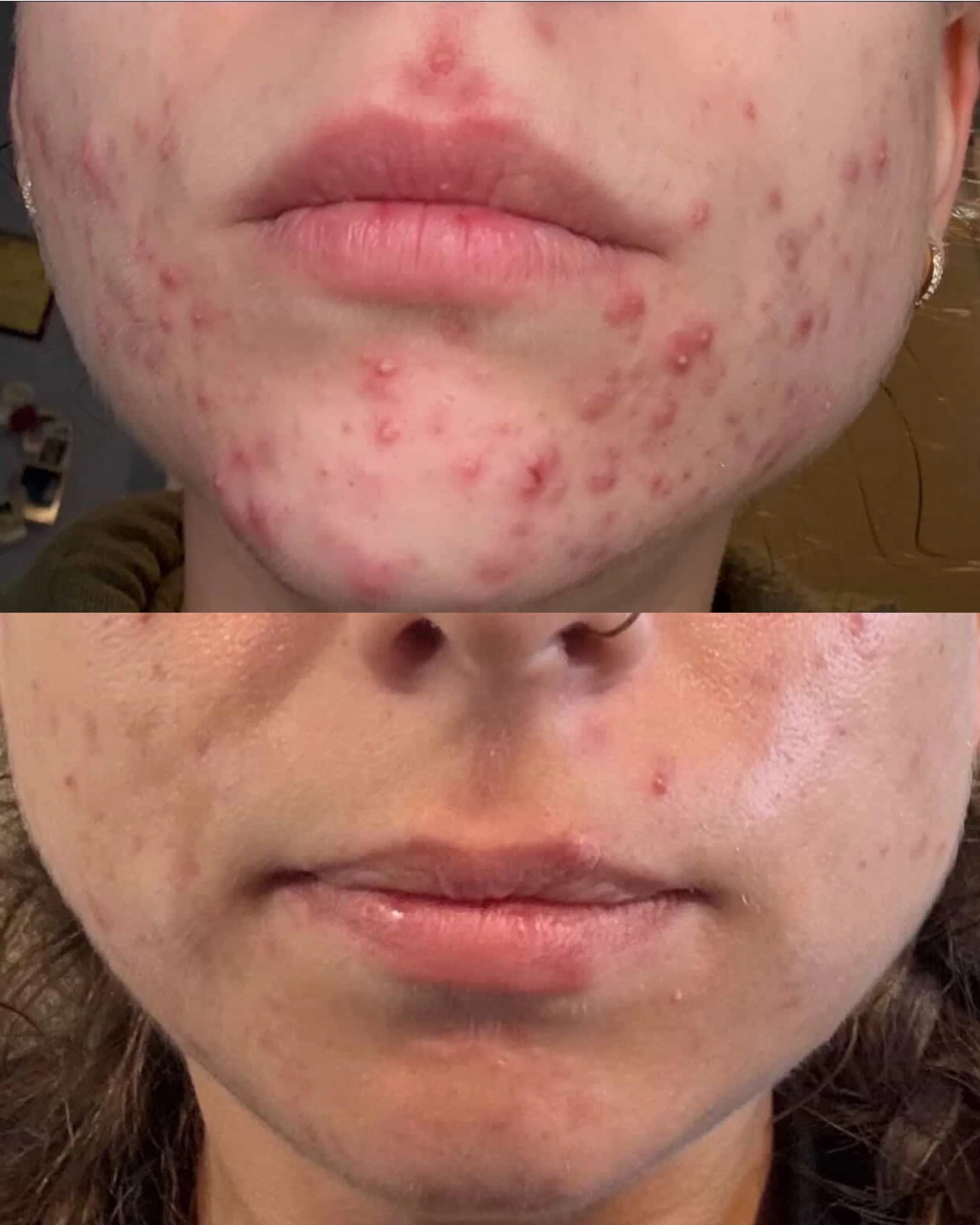 customized skincare regimen. two acne signature treatments. 8 weeks. 🤯

healing skin takes patience and consistency. 🙌🏼

🧖🏻&zwj;♀️ @colladocollective 

📞 717.900.1390 | #BlossomYork