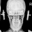 Frontal xray.jpg