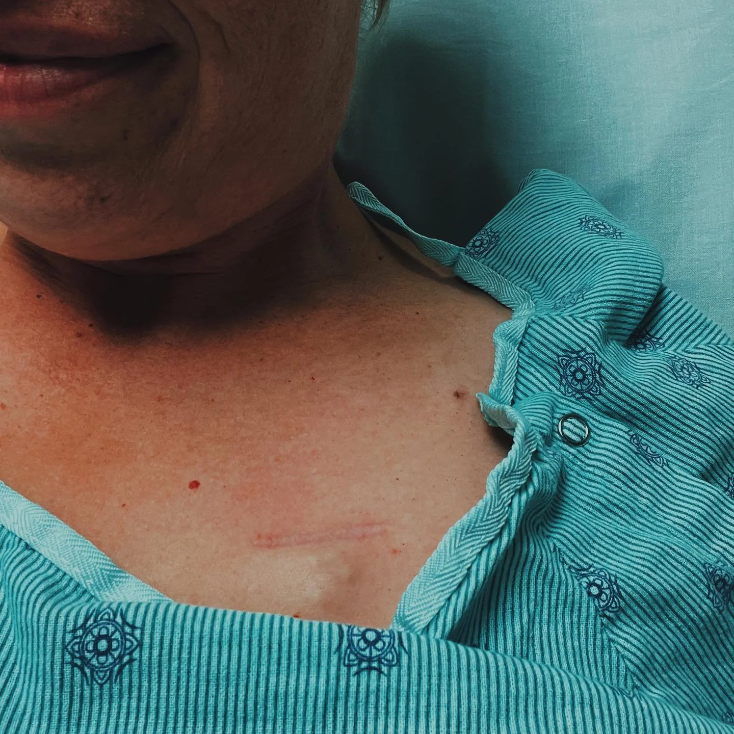 I had surgery today! It all went great.

I swapped my expanders for implants. They are so much softer and I am so thankful. Way more comfortable for sure. My dear plastic surgeon cleaned up my back scar from my Lat Flap last July. I also got my port 