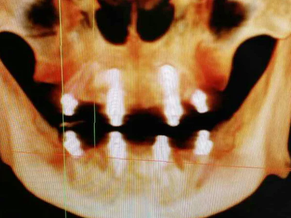 CEREC