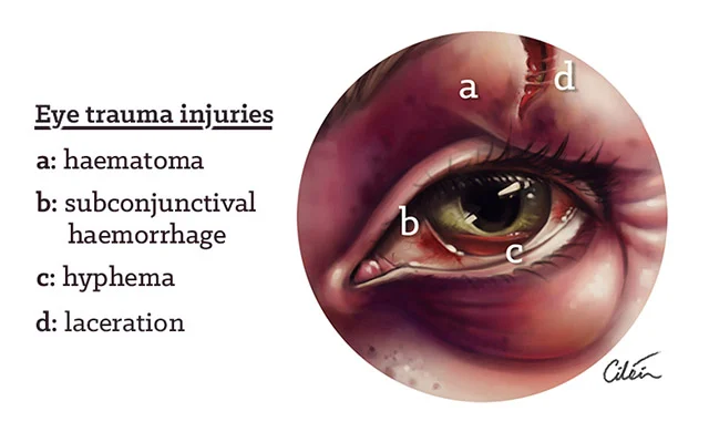 Entrapment Of Eye , Orbital Medial Wall Fractures – TFAPRC