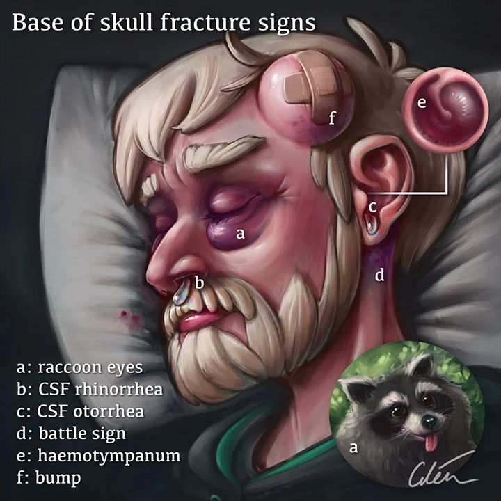 5 signs of a base of skull fracture — artibiotics