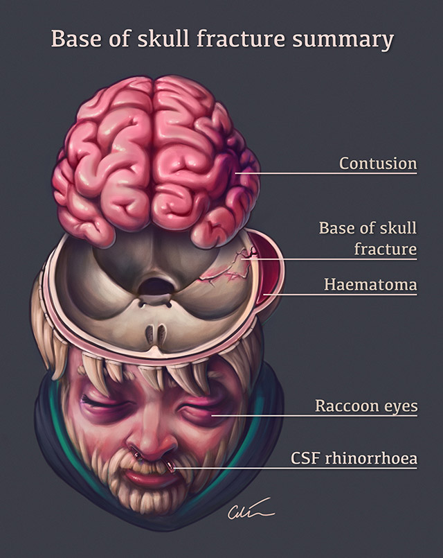 Skull fracture signs of basilar 