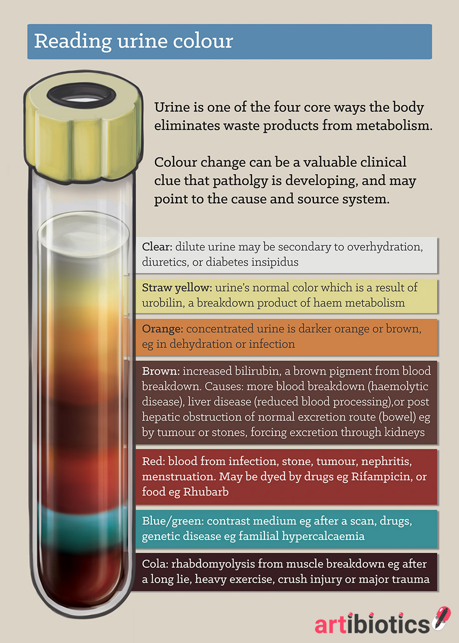 Kidney Failure Urine Color Chart