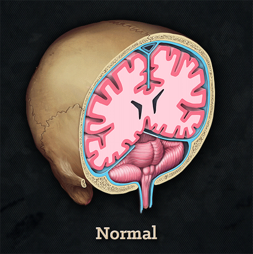 herniation-animated-cilein-kearns-artibiotics.gif