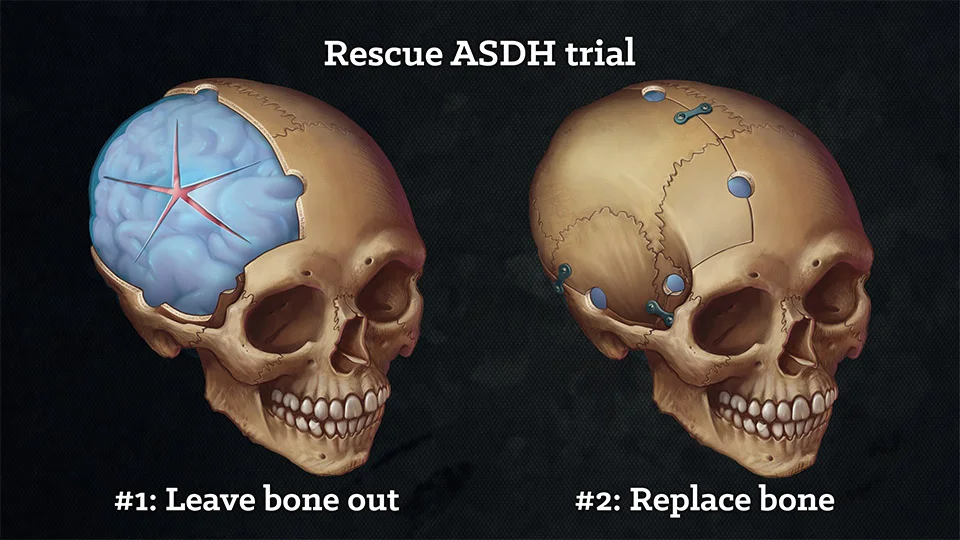 The Rescue ASDH trial is studying whether leaving the bone flap out, or replacing it, is the better option in ambiguous cases of craniotomy decompression of ASDH.