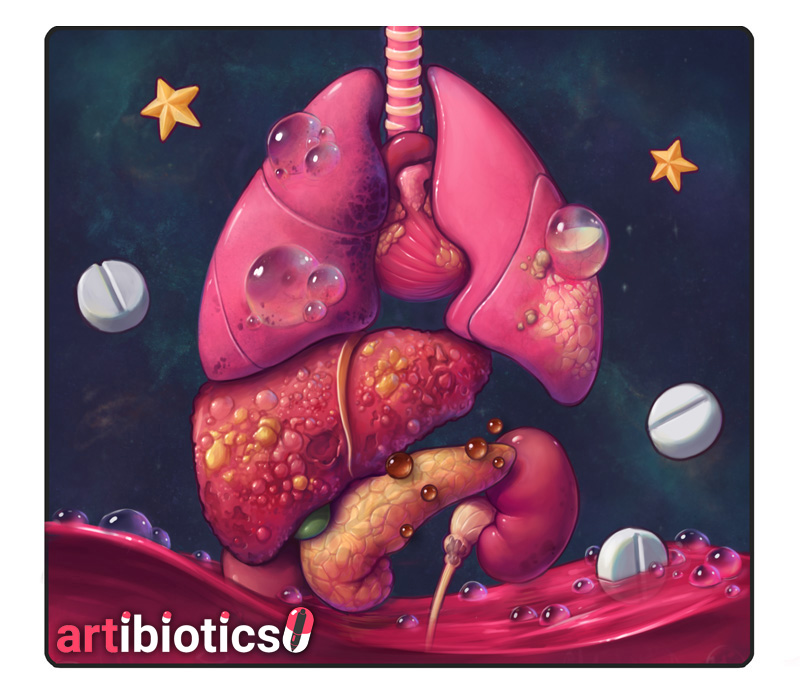 The (illustrated) H's & T's: aka reversible causes of cardiac arrest —  artibiotics