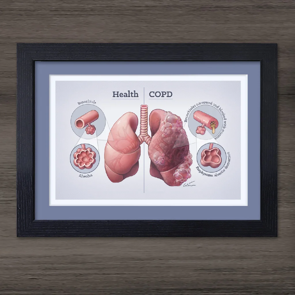COPD preview mounted.jpg