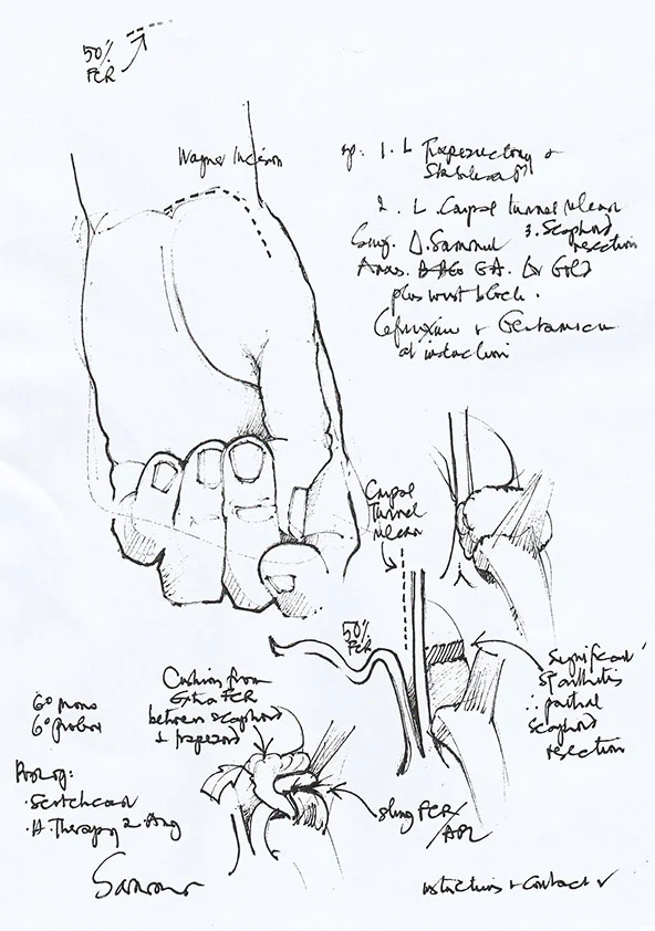 Figure 3. ‘Trapezectomy and stabilisation’ illustrated operation note drawn by Mr Donald Sammut, Consultant Hand Surgeon, UK, ( Working Hands ).