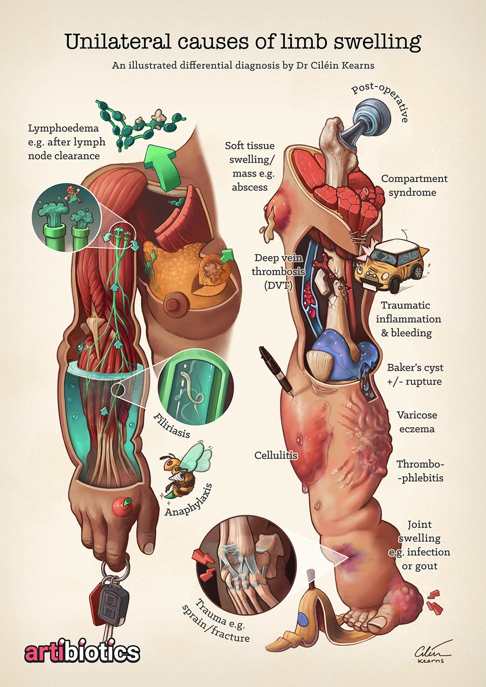 Causes Of Limb Swelling Artibiotics