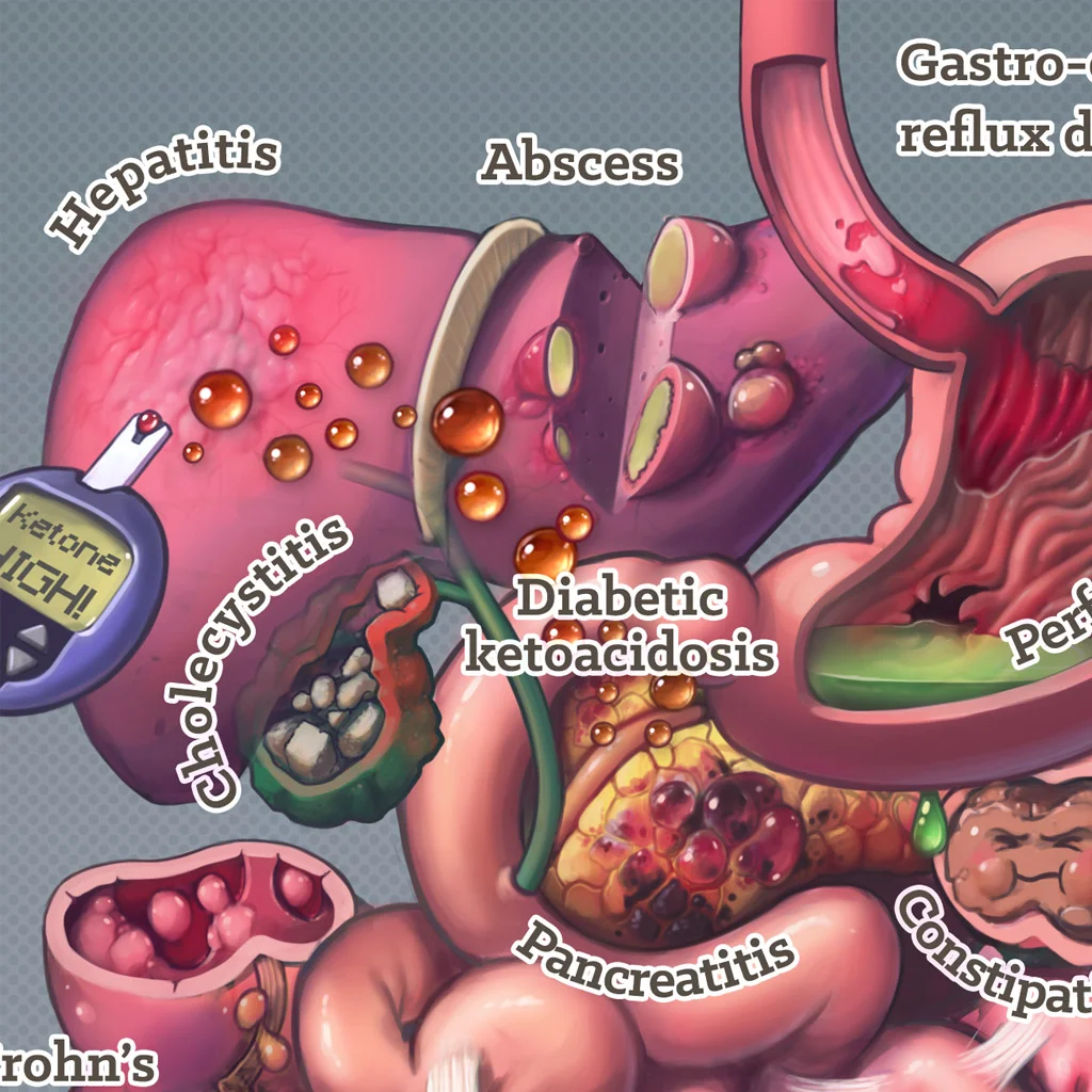 preview causes of abdo pain close up 01.jpg