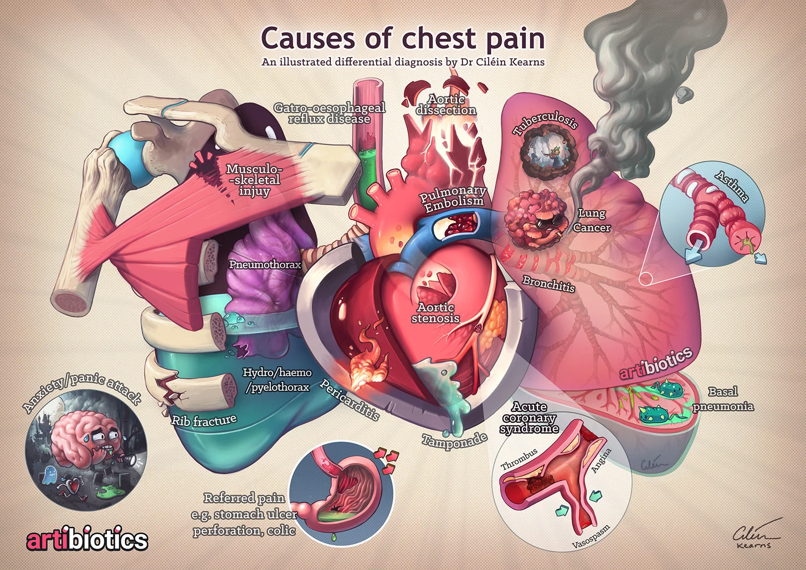 Causes Of Chest Pain Artibiotics