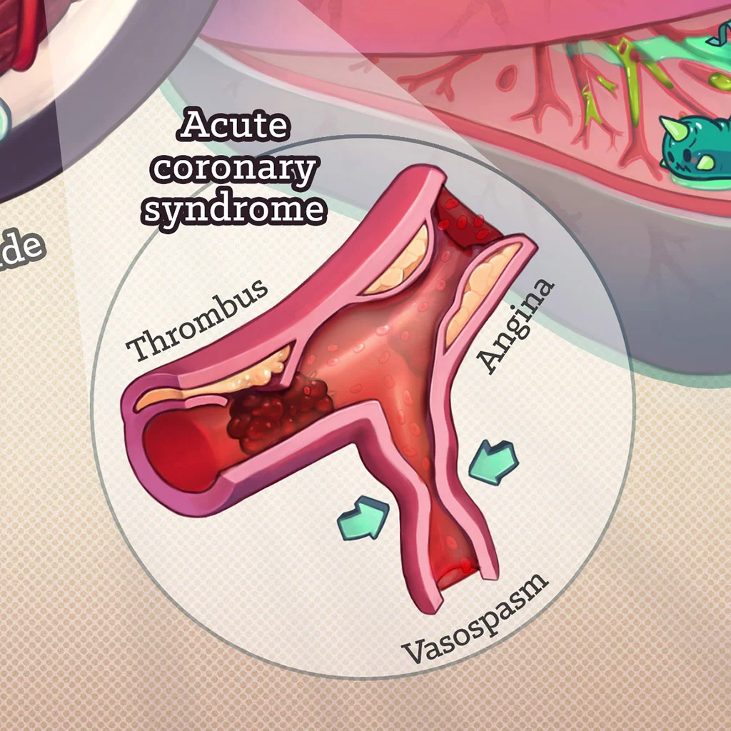 Causes of chest pain CU 02 1024px.jpg