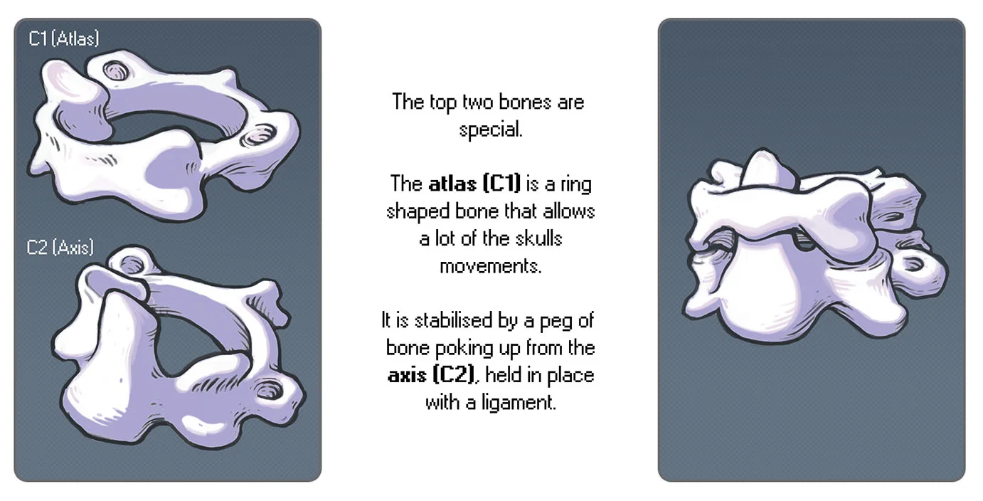 Fixing a broken neck: an illustrated case journey by Dr Cilein Kearns Artibiotics.jpg