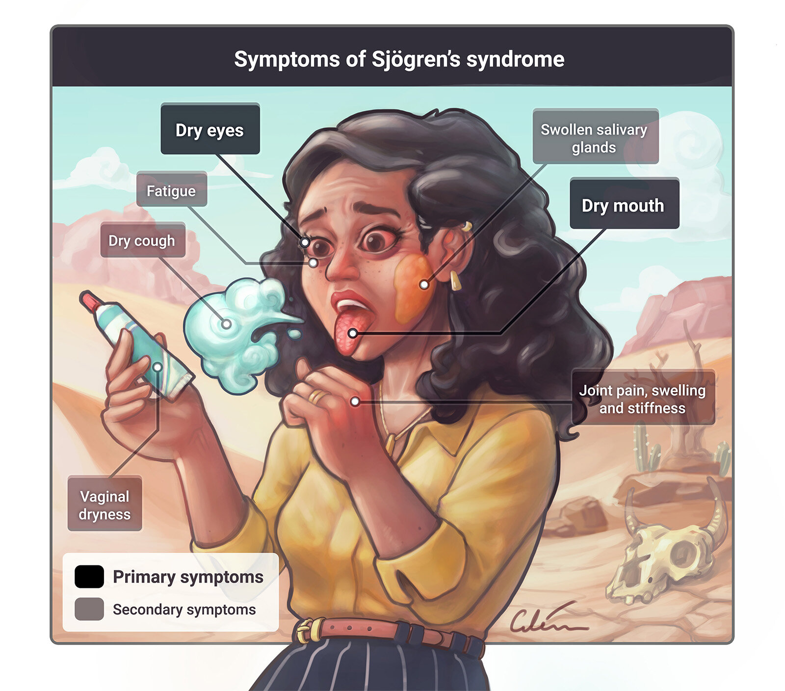 Sjögren's syndrome illustrated — artibiotics