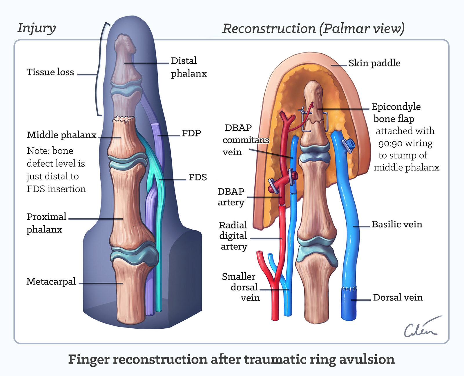 DBAP flap finger reconstruction by Dr Cilein Kearns (artibiotics) screen v3.jpg