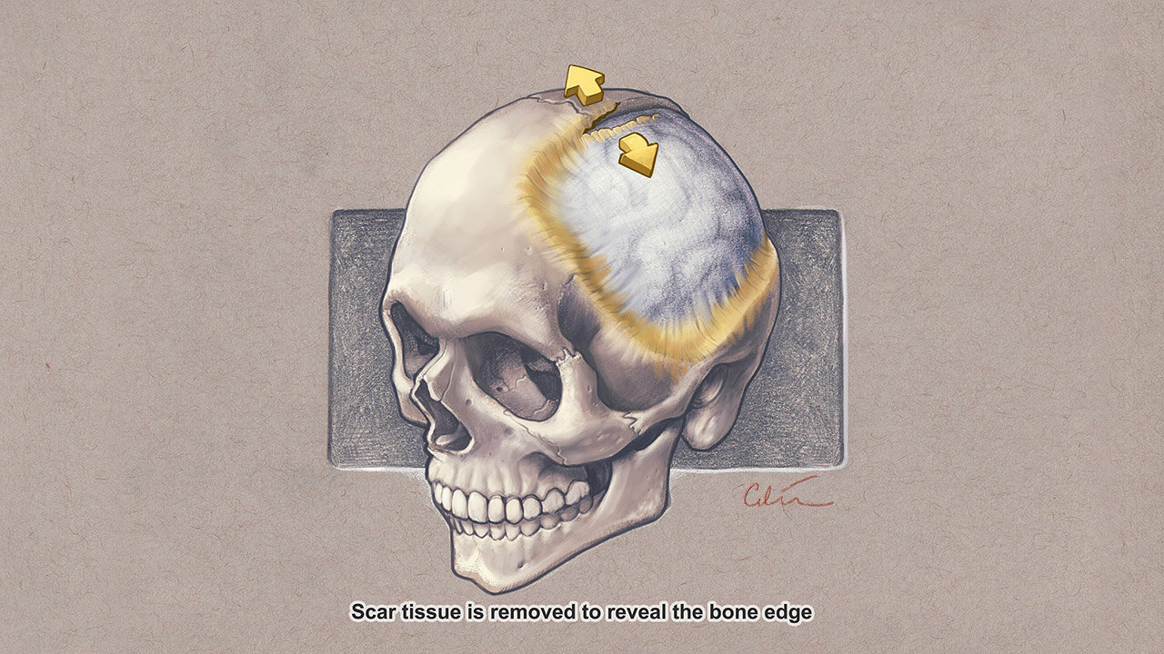 Cranioplasty sequence by Dr Cilein Kearns Artibiotics p03.jpg