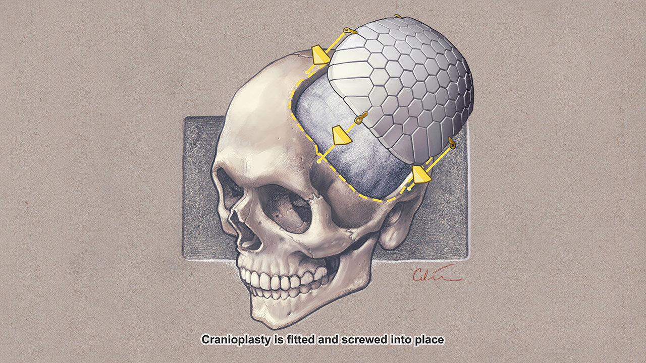 Cranioplasty sequence by Dr Cilein Kearns Artibiotics p05.jpg